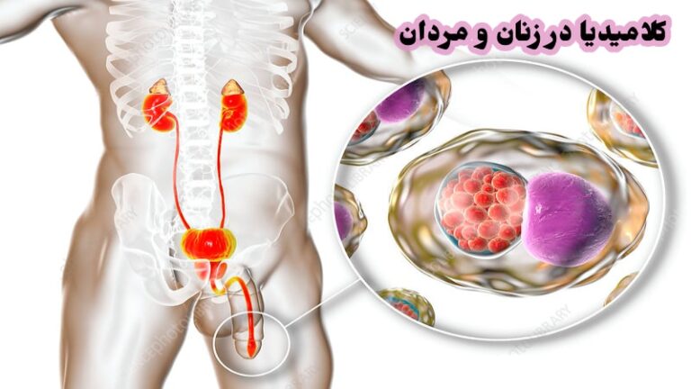 کلامیدیا