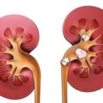 بیماری مزمن کلیه نهمین علت مرگ در جهان شد