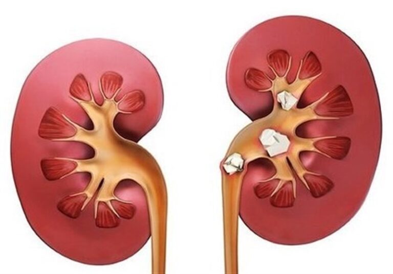 بیماری مزمن کلیه نهمین علت مرگ در جهان شد