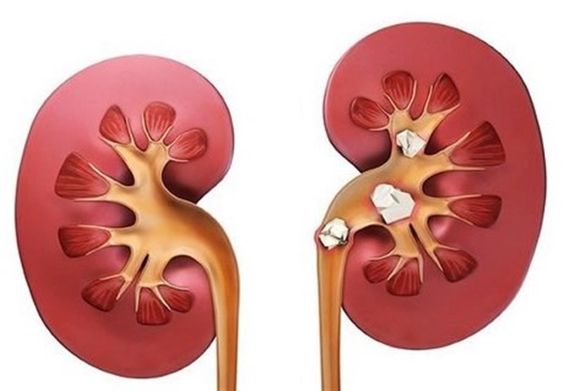 بیماری مزمن کلیه نهمین علت مرگ در جهان شد
