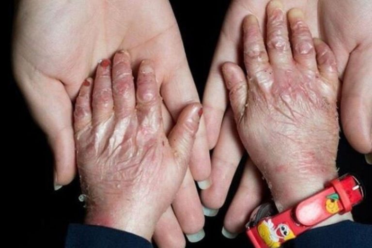 ۹۵ درصد بیماران «ای بی» حاصل ازدواج فامیلی