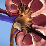 ایران روی کمربند سنگ کلیه قرار دارد