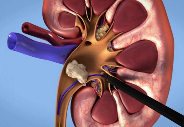 ایران روی کمربند سنگ کلیه قرار دارد
