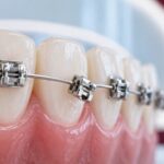 شکستن براکت ارتودنسی