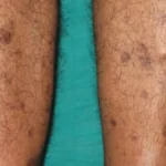 علائم بالینی سیاه شدن پوست پا و نکروز بافتی؛ راهنمای پیشگیری و درمان زخم‌های پیشرفته کپی عنوان